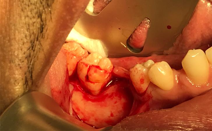 After Cyst Removal
