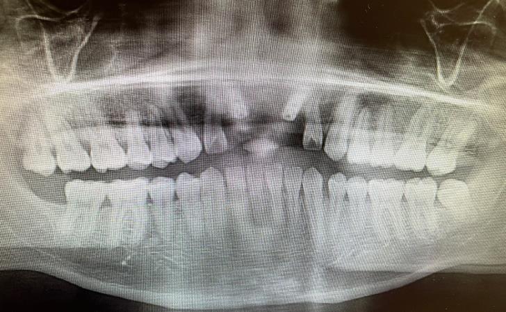 After Dental Implants Procedure