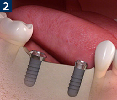 Multiple Tooth Replacement Using Dental Implants