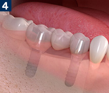 Dental Implants To Replace Multiple Teeth
