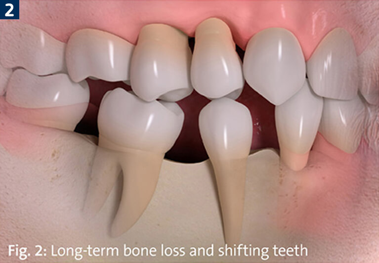 Loss Of Jaw Bone Density