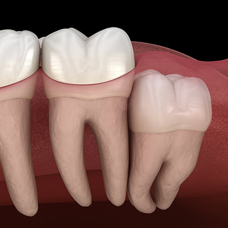 Wisdom Teeth Impactions